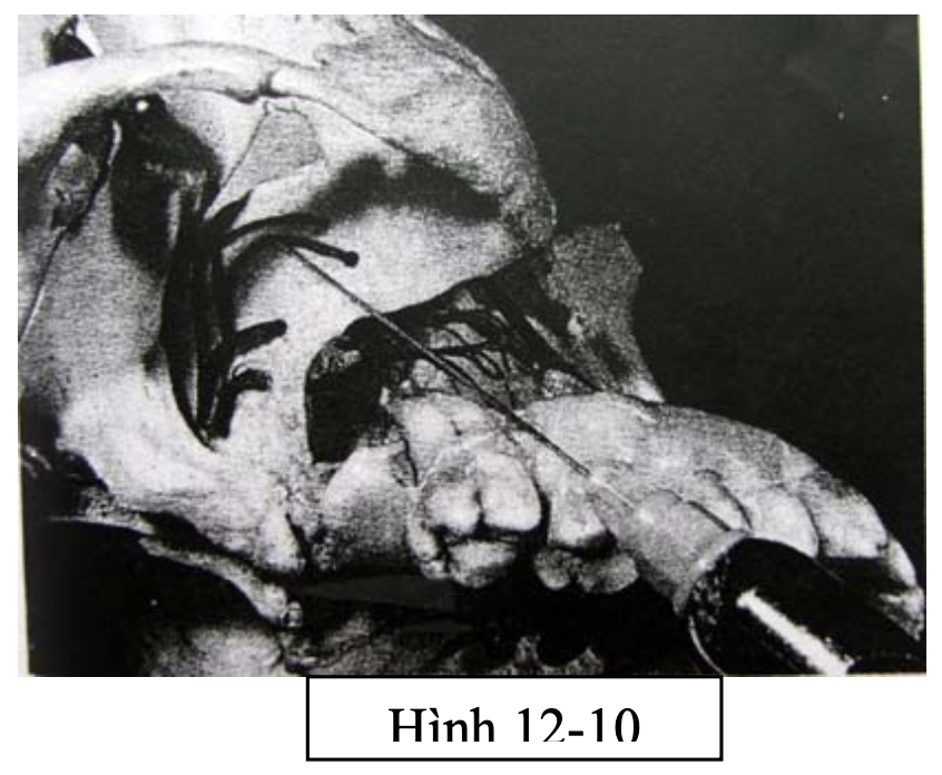 Tiểu phẫu răng khôn hàm trên